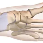 Anatomische Darstellung eines Hallux valgus