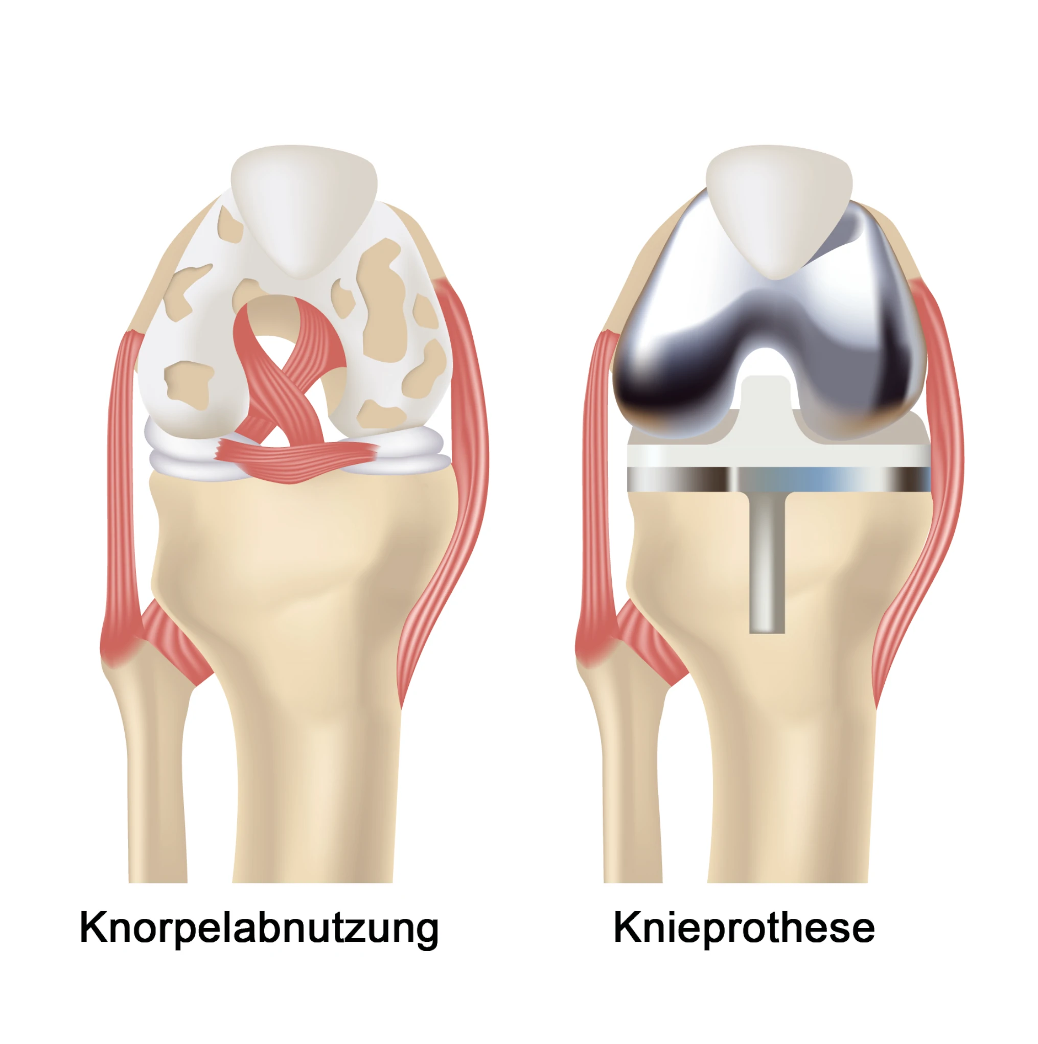Vergleich arthrotisches Knie mit Knieprothese